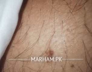 Normal Mole?
