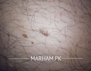 Normal Mole?