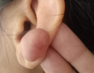 Ear Piercing Bump