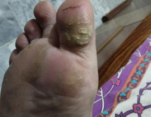 Skin Problem