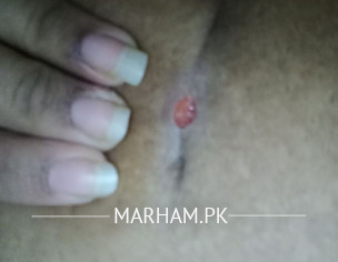 C Section Scars