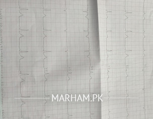 ECG Report