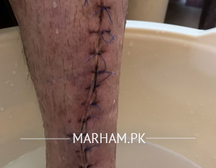 Broken Leg Pain