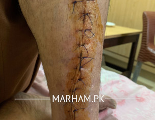 Broken Leg Pain