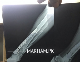 Broken Leg Pain