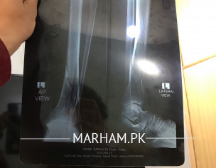 Broken Leg Pain