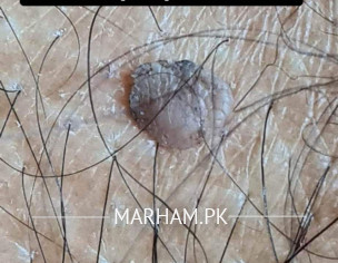 Skin Problem