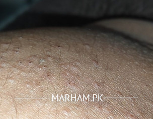 Skin Problem