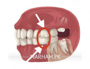 Dental Issue