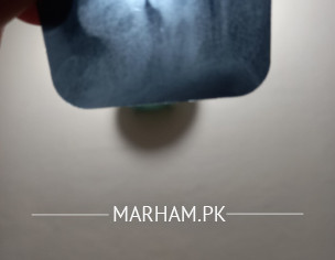 Wise Tooth Removal