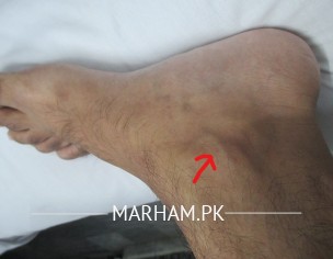 Ankle Problem