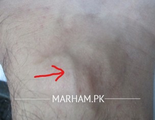 Ankle Problem