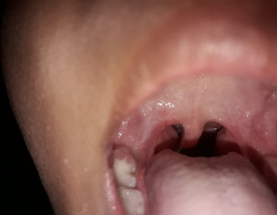 Tonsillitis