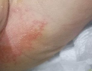 Small Pimples