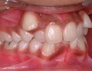 Braces