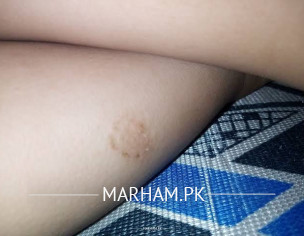 Severe Eczema