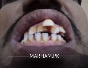 Tooth Problem