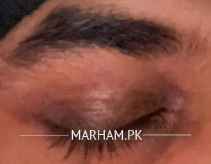 Eyes Darkcircle