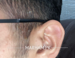 Seborrheic