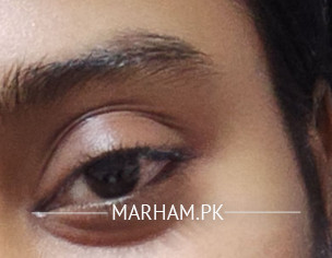 Eye Issue