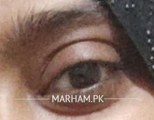Eye Issue