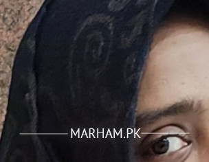 Eye Issue