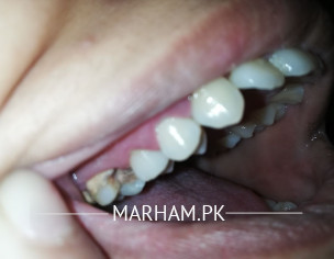 Tooth