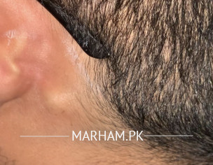 Bump Behind Ear