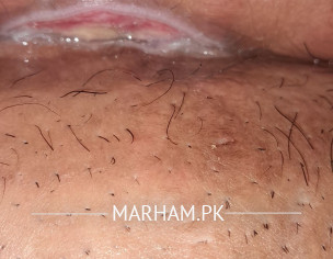 C Sec Wound