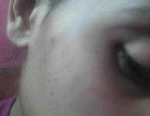 Pigmentation
