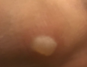 Skin Bump