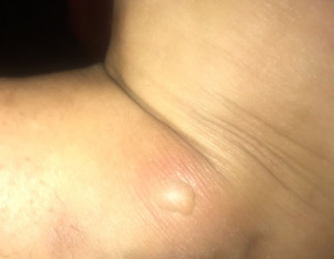 Skin Bump