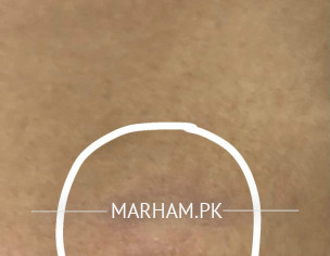 Ringworm Shaped On Belly