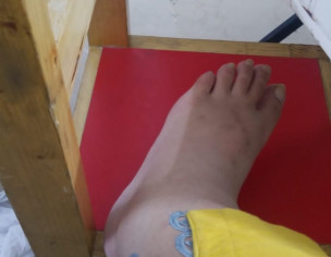 Feet Swollen