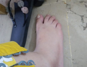 Feet Swollen