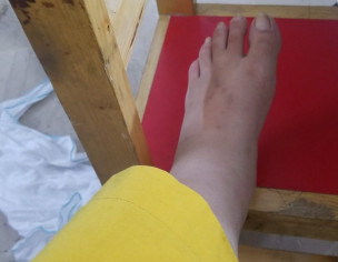 Feet Swollen