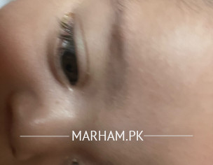 Eye Infection