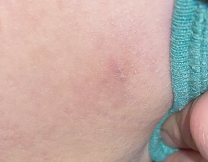 Lump Under Skin