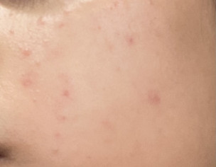 Acne, PIE, Redness