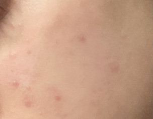 Acne, PIE, Redness