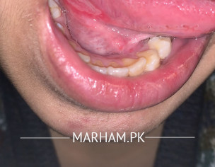 Mouth Blisters