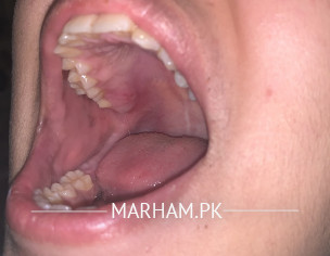 Mouth Blisters