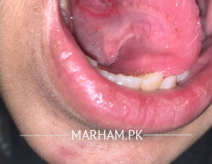 Mouth Blisters