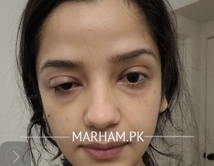 Eye Infection 