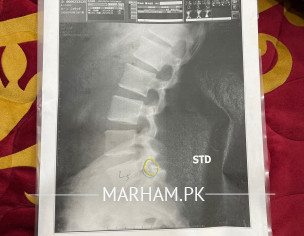 Back Pain 