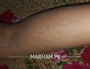 Striae Problem