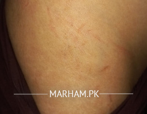 Striae Problem
