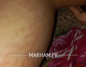 Striae Problem