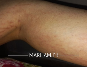 Striae Problem
