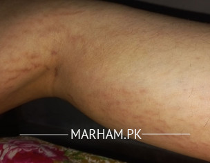 Striae Problem